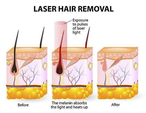 SmoothBeam Laser Hair Remover